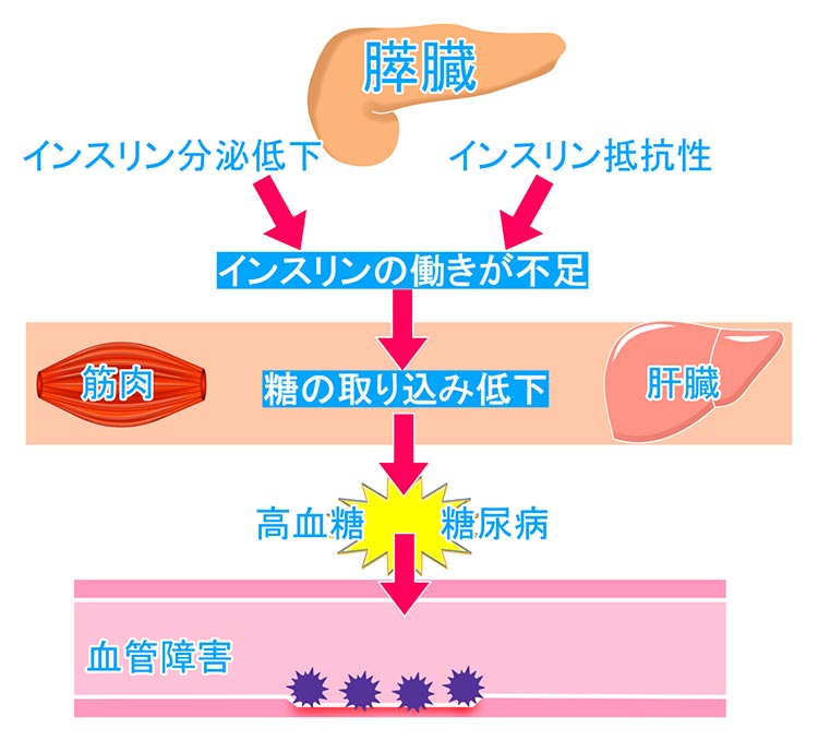 糖尿病の種類イメージ